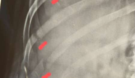 De quebrarse cinco costillas, al podio