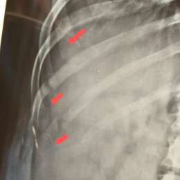 De quebrarse cinco costillas, al podio