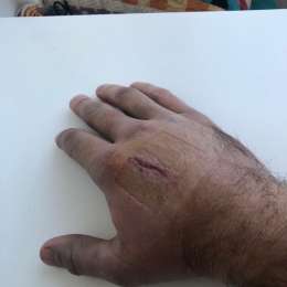 De Benedictis mostró cómo está la mano lastimada